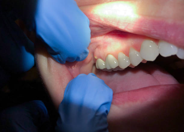Best Emergency Broken Tooth Repair in Canadian Lakes, MI